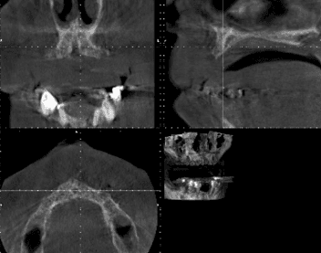 Multiple CT scan views showing cross-sections of jaw and teeth
